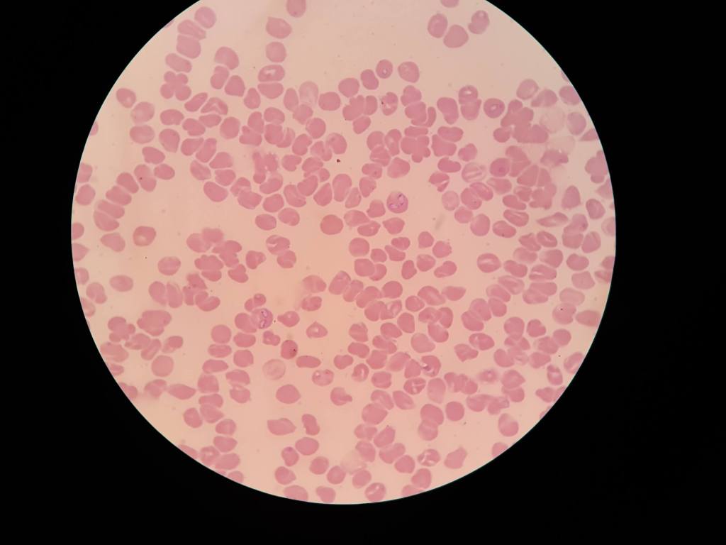 Babesiosis canina